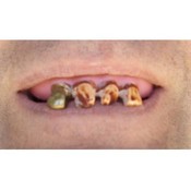 Fake gold tooth Teeth.